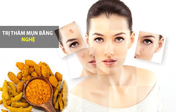 Mách nhỏ chị em cách trị mụn thâm, làm trắng da 1 