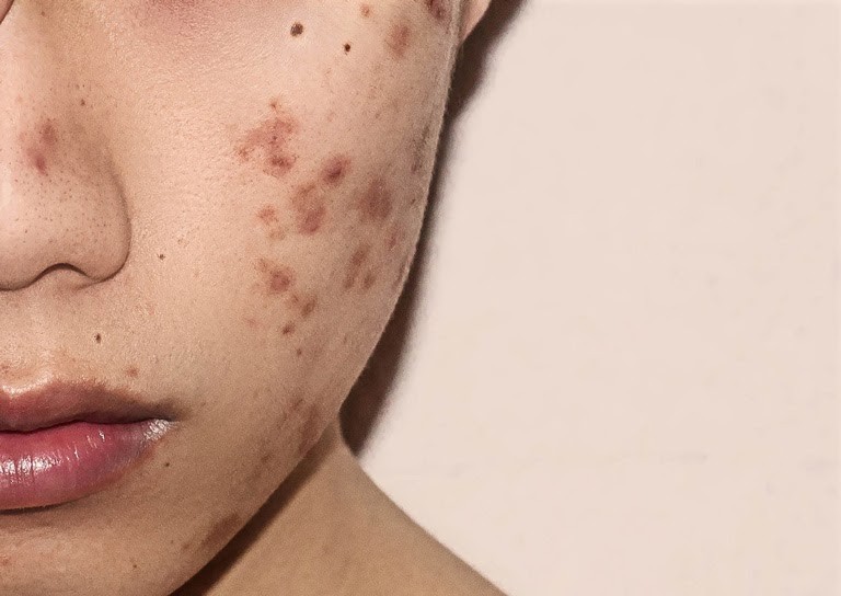 Chia sẻ các cách trị mụn thâm kinh nghiệm dân gian 1