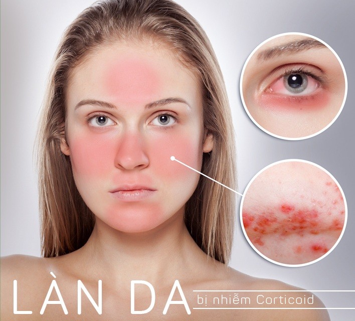 Da nhiễm độc tố corticoid trong mỹ phẩm là như thế nào? 1