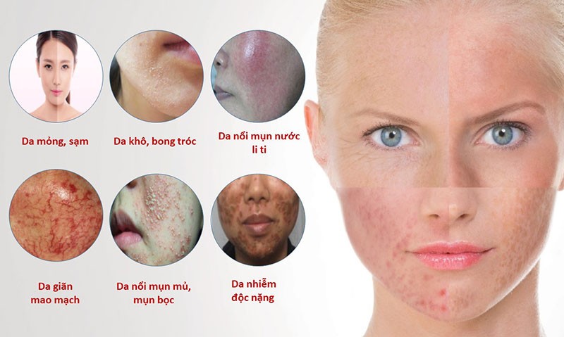 Da nhiễm độc tố corticoid trong mỹ phẩm là như thế nào? 2