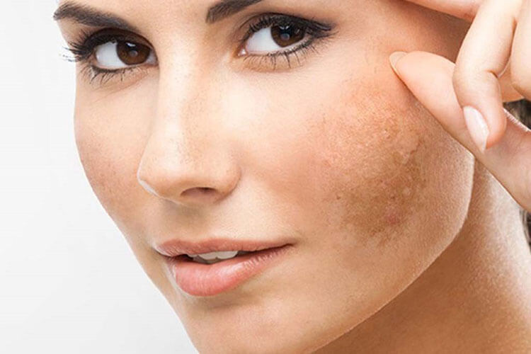 Mách nhỏ chị em cách trị nám da tự nhiên chỉ với 0 đồng 1