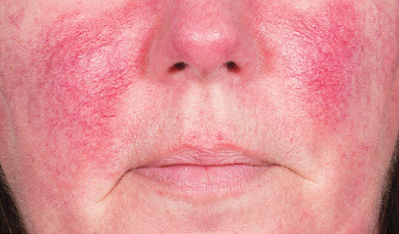 Da nhiễm độc tố corticoid trong mỹ phẩm là như thế nào? 3