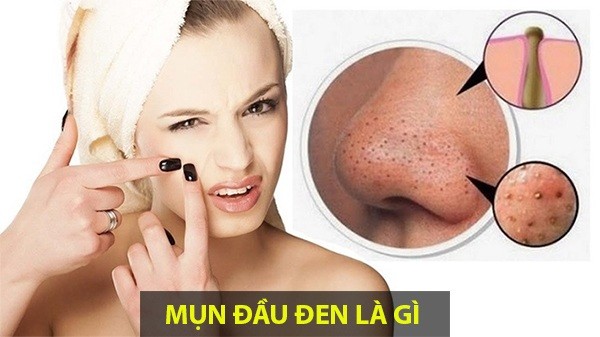 Tuyệt chiêu dùng sữa rửa mặt trị mụn đầu đen 1