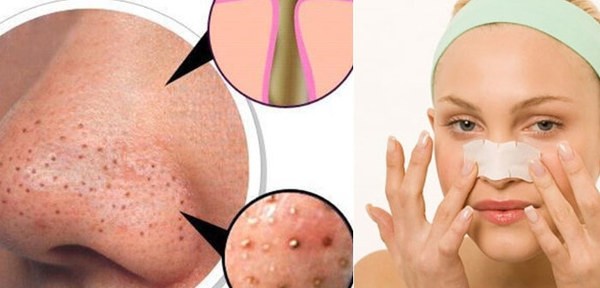 Tạm biệt ngay mụn đầu đen