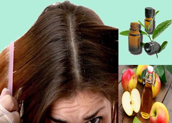  Tạm biệt gàu nhanh chóng nhờ những cách trị gàu tại nhà đơn giản 2
