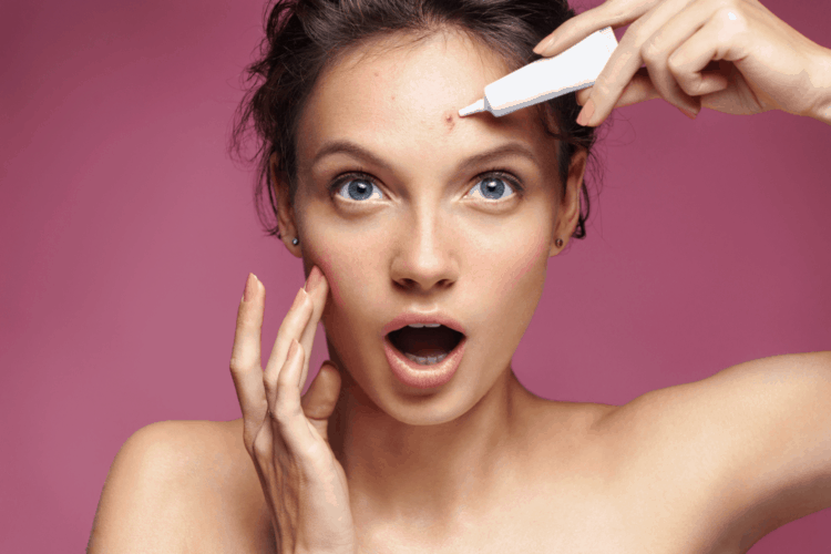 Chia sẻ mẹo trị mụn dứt điểm thần thánh 1