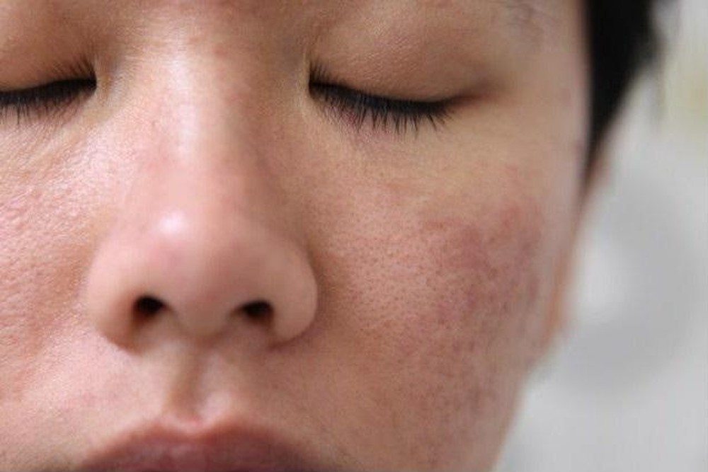 Đọc ngay mẹo làm nhỏ lỗ chân lông cho da mịn màng  1