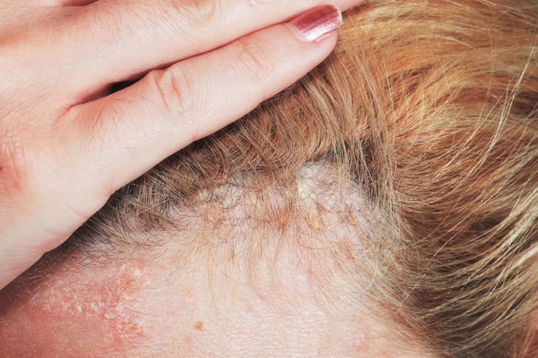 Triệu chứng da đầu tróc vảy, mẩn đỏ 1