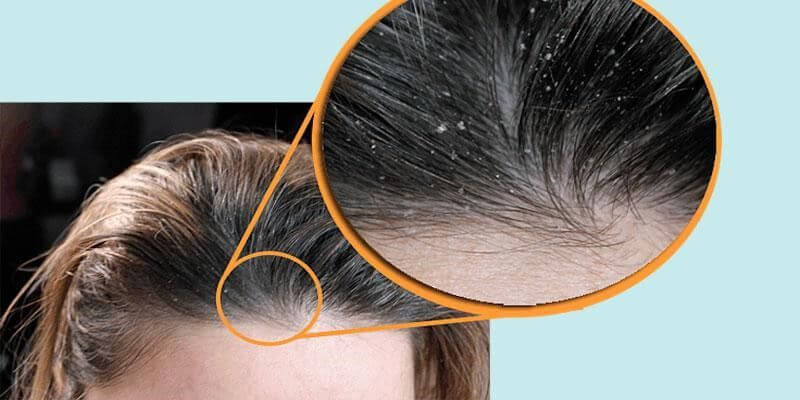 Tìm hiểu những nguyên nhân gây gàu phổ biến nhất 1