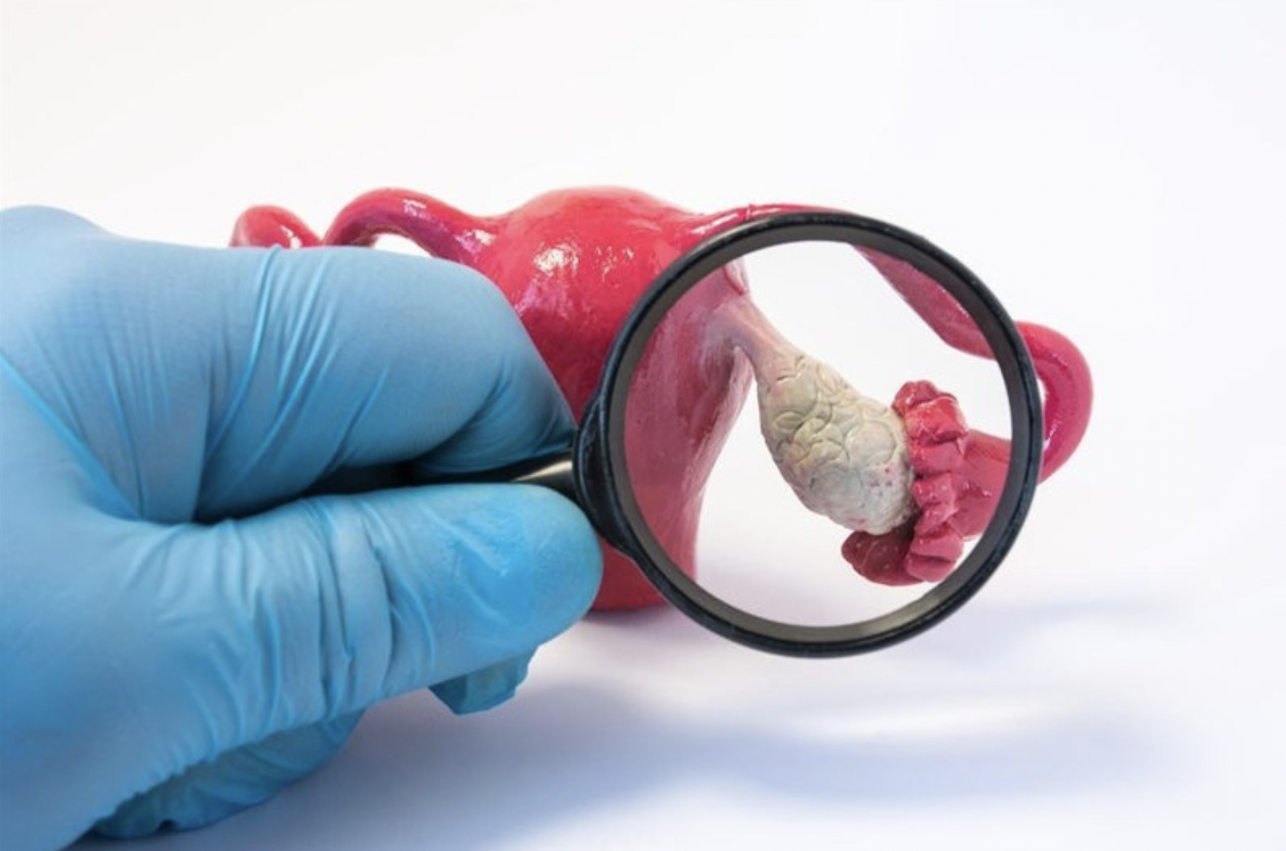POLYCYSTIC OVARY SYNDROME (PCOS)