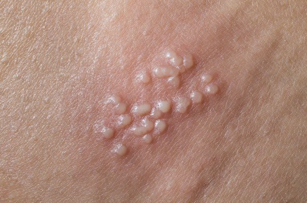 Virus Herpes cũng là một trong những thủ phạm khiến vùng kín bị ngứa
