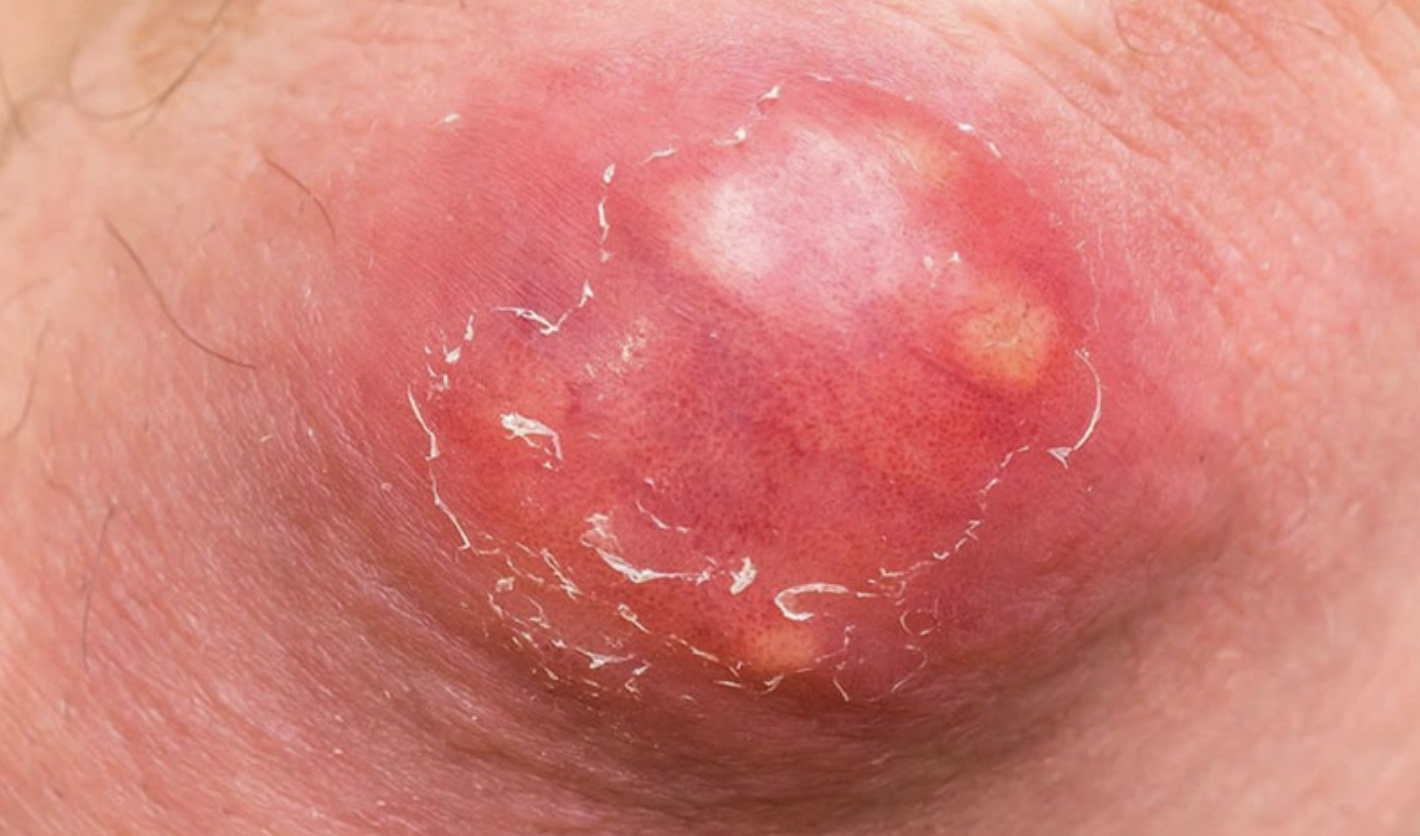 Nguyên nhân gây mụn nhọt ở vùng kín