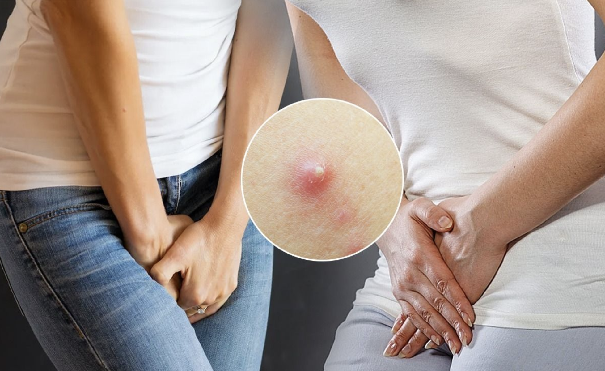 Mụn nhọt ở vùng kín: Nguyên nhân và cách khắc phục