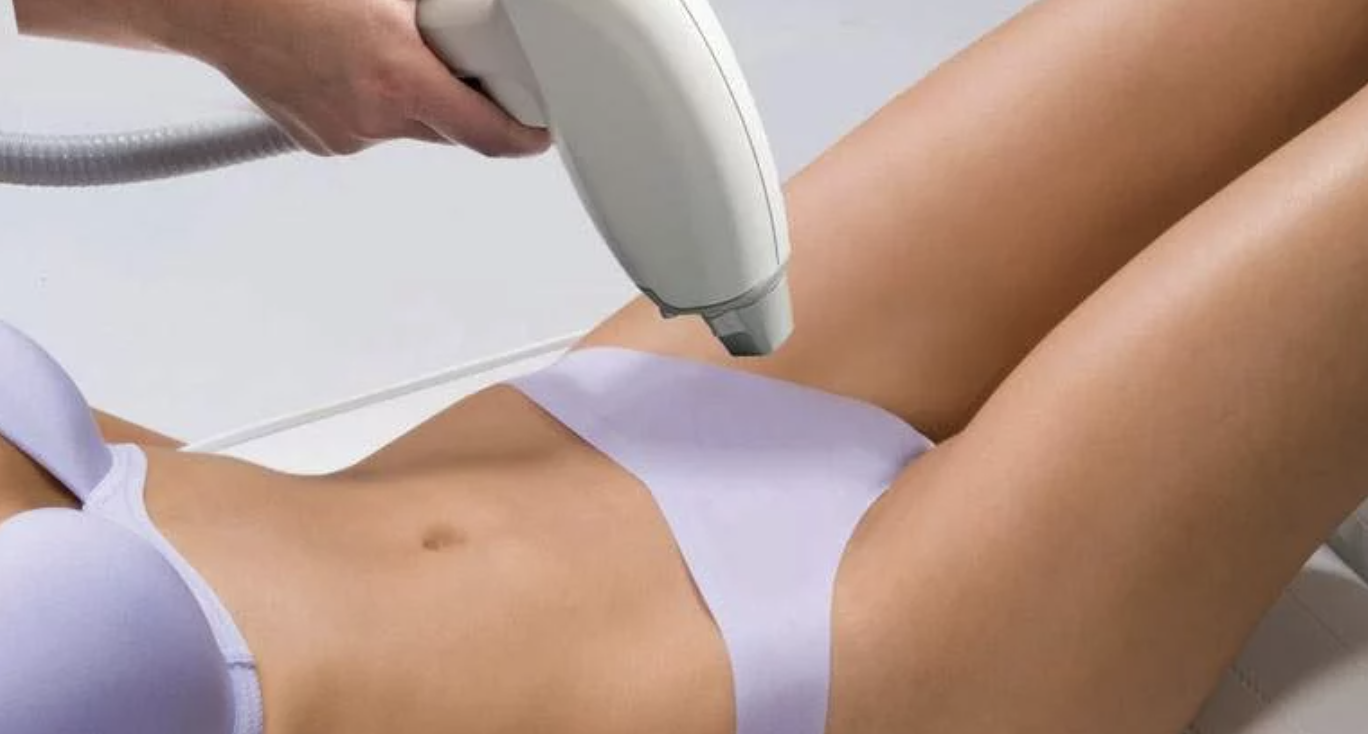 Triệt lông vùng kín bằng Laser