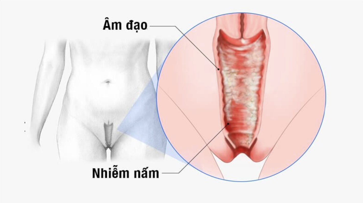 Nhiễm nấm Candida albicans là nguyên nhân phổ biến nhất gây ngứa âm đạo bên ngoài